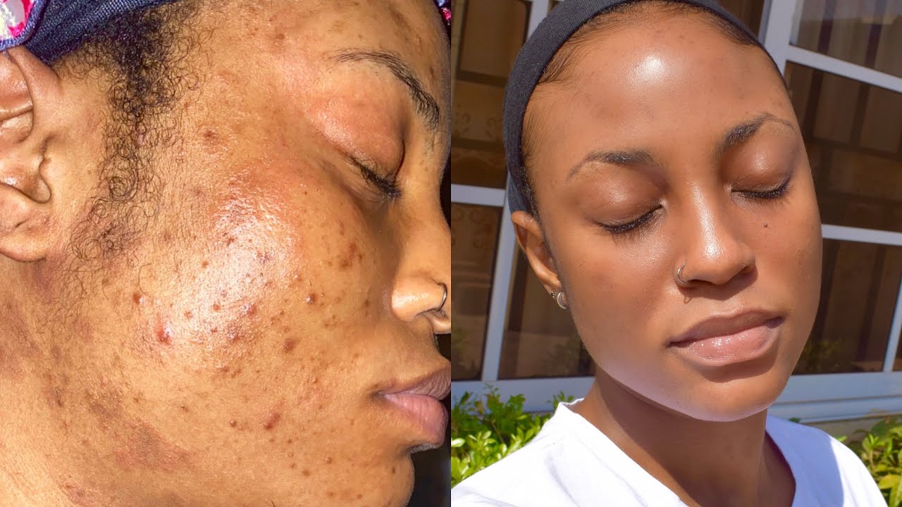 Combo Set for Oily, Acne-Prone Skin: The Best Ingredients You Need!