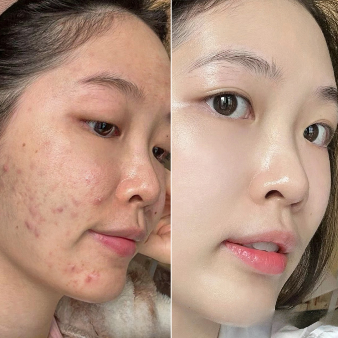 Combo Set for Oily, Acne-Prone Skin: The Best Ingredients You Need!