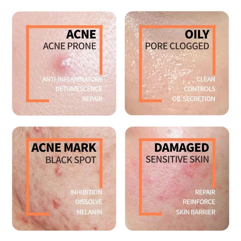 Niacinamide 10% + Zinc 1%