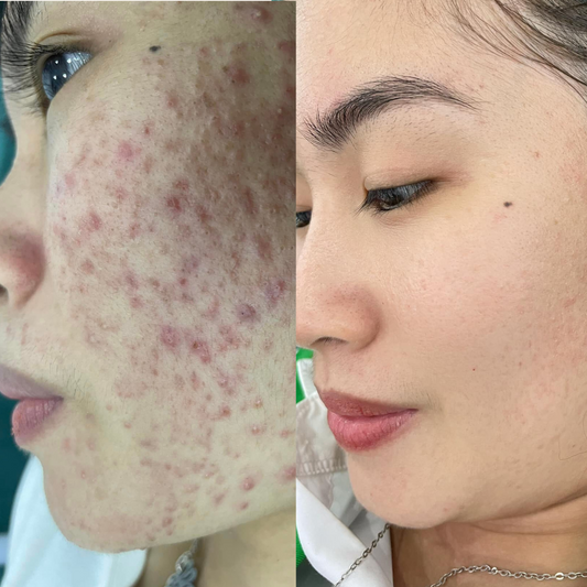 Combo Set for Oily, Acne-Prone Skin: The Best Ingredients You Need!