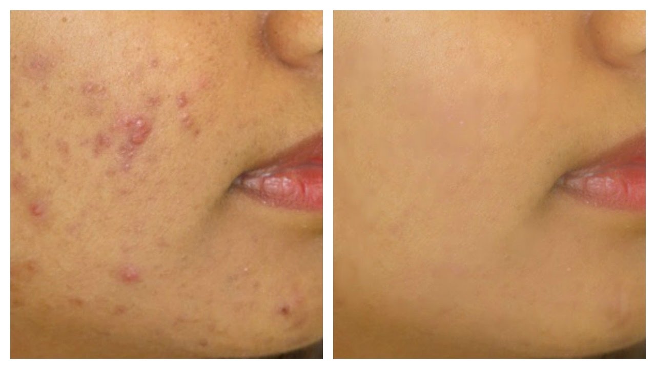 Combo Set for Oily, Acne-Prone Skin: The Best Ingredients You Need!