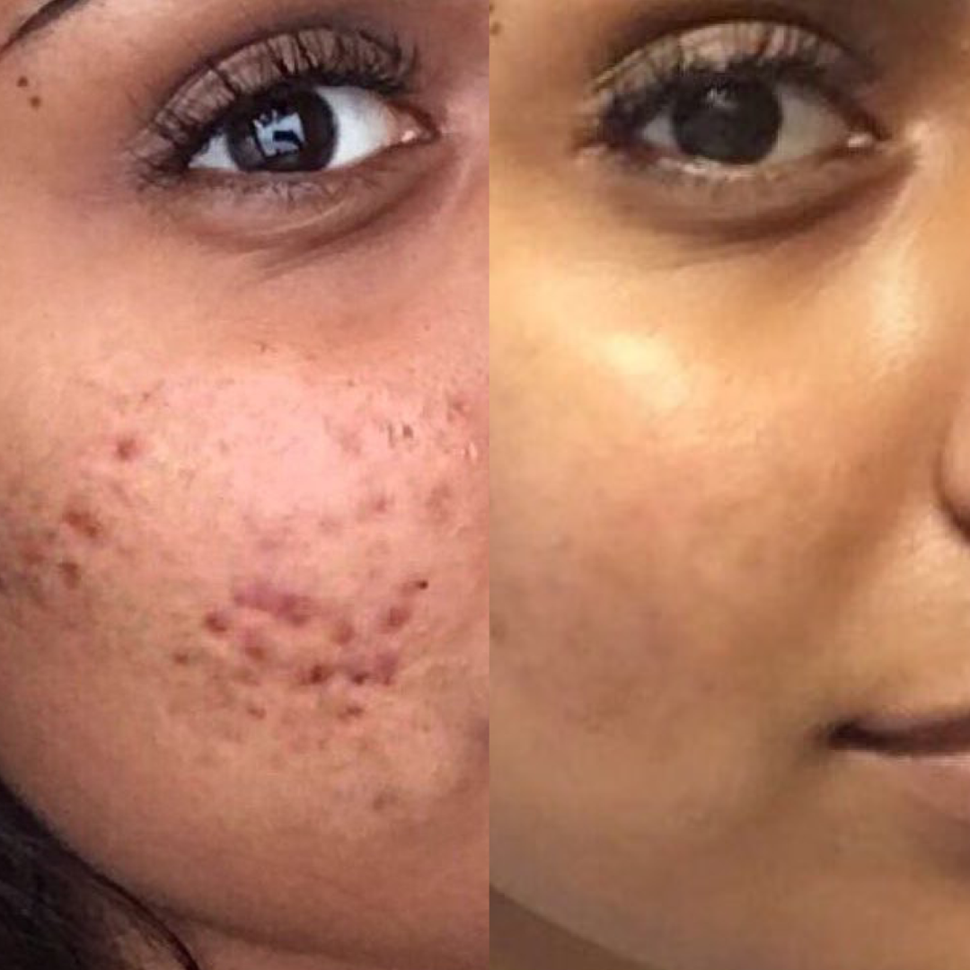 Combo Set for Oily, Acne-Prone Skin: The Best Ingredients You Need!