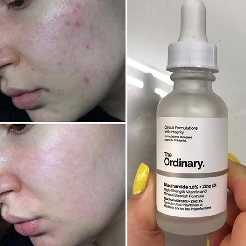 The Ordinary Glow & Clear Skin Bundle – 100% Orginal | Fast UAE Delivery