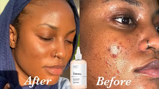The Ordinary Glow & Clear Skin Bundle – 100% Orginal | Fast UAE Delivery