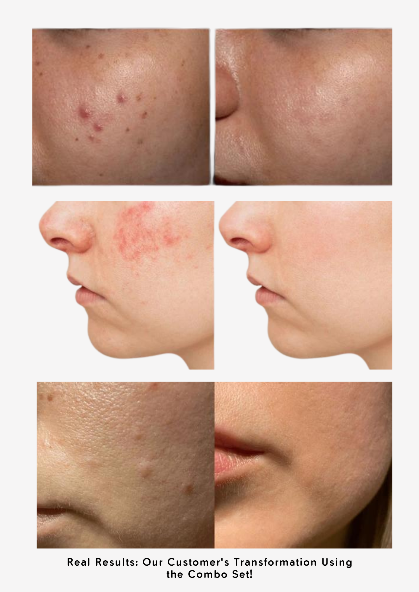 Combo Set for Oily, Acne-Prone Skin: The Best Ingredients You Need!