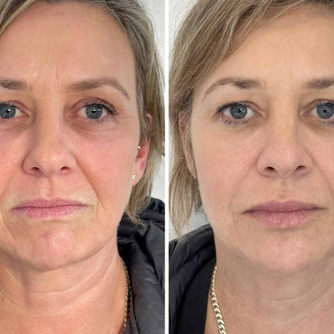 Youthful Skin Combo Set – Reduce Fine Lines & Wrinkles