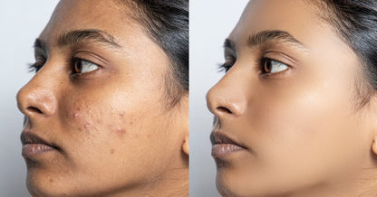 Combo Set for Oily, Acne-Prone Skin