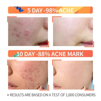 Niacinamide 10% + Zinc 1%