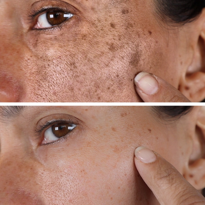 Combo Set – For Melasma, Pigmentation, and Dark Spots Gone!