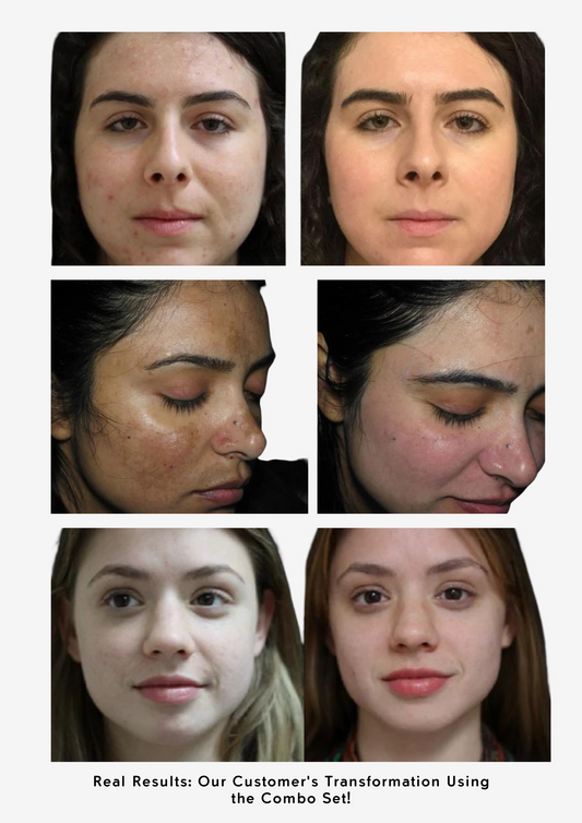 Combo Set – For Melasma, Pigmentation, and Dark Spots Gone!